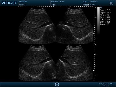 Liver - 4B(002)