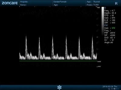 Palmar Vessels - PW FSI(001)