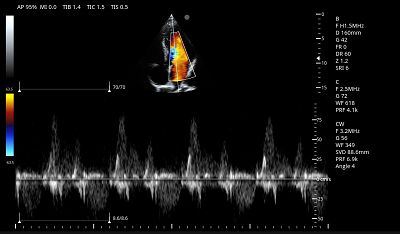 Cardiac CW Mode(001)