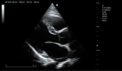 Cardiac LV long Axis(001)